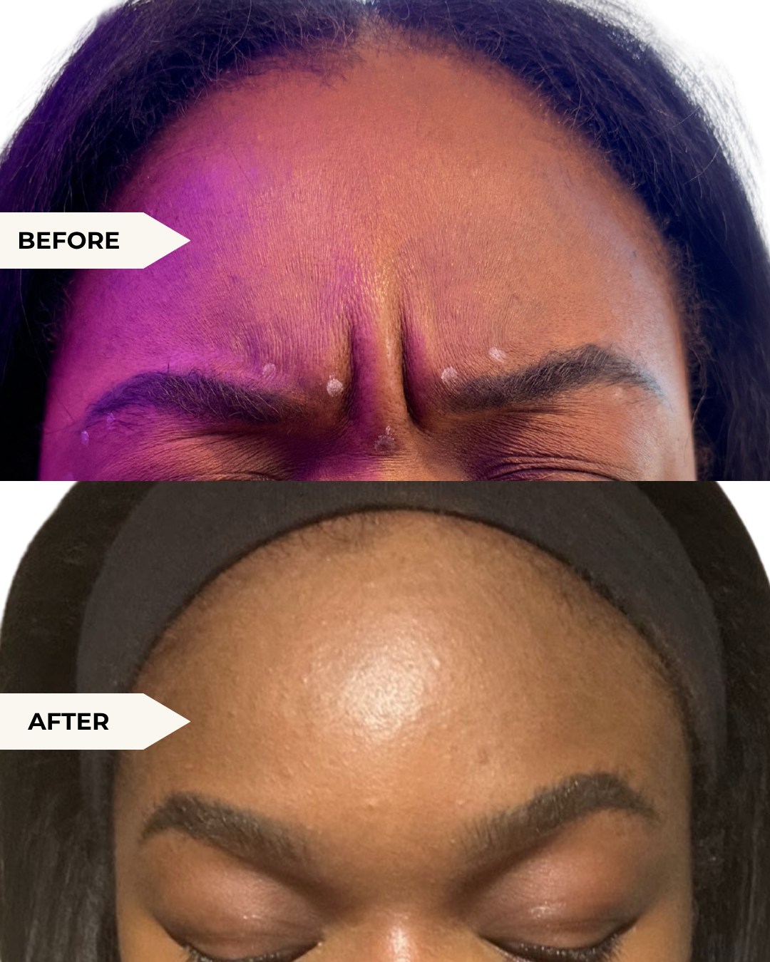 Before-and-after comparison showing the forehead and glabellar area at rest