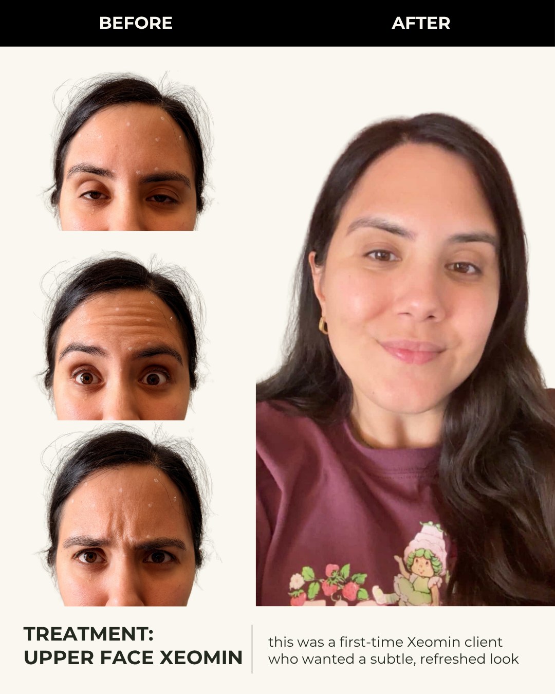 Before-and-after comparison of an upper-face Xeomin treatment for a first-time client seeking a subtle, refreshed look
